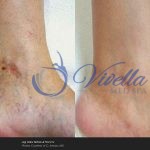 Vein Treatments