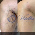 Vein Treatments