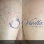 Vein Treatments